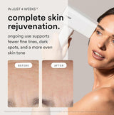 Nood™ NEW Flasher Pro — IPL Hair Removal Device & Anti-Aging Red Light Therapy for Women & Men — Pain-free, Permanent, Visible Results After First Use & Works Everywhere Hair Grows — Gloss White